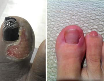 Negligent Pedicares can result in Painful Injuries