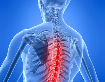 Back or spine injury leading to paralysis, paraplegia, or quadriplegia