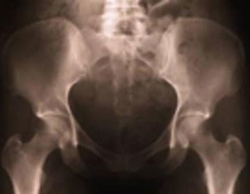 Tailbone Injury X-Rays