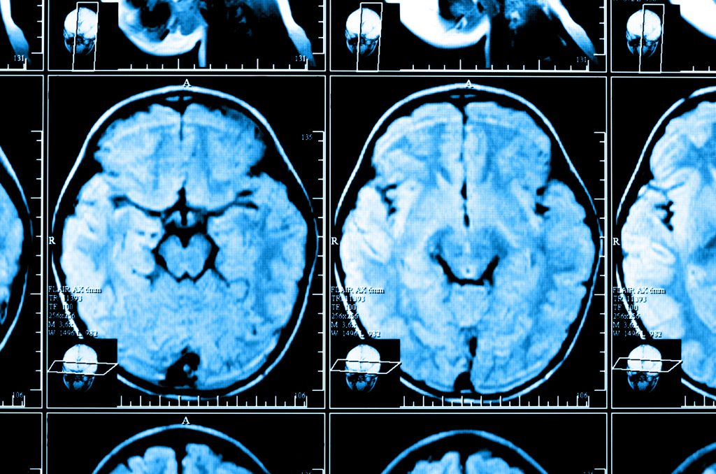 brain scan after an injury